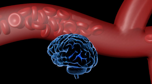 বাংলাদেশে মৃত্যুর দ্বিতীয় প্রধান কারণ স্ট্রোক
